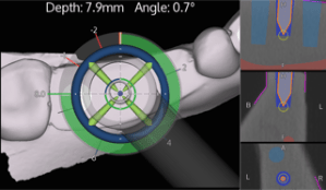 Example of digital image produced by using x-guide dynamic 3D navigation