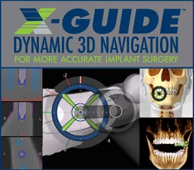 X-Guide Dynamic 3D Navigation- for more accurate implant surgery