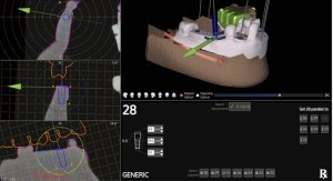 Example of digital image produced by using x-guide dynamic 3D navigation