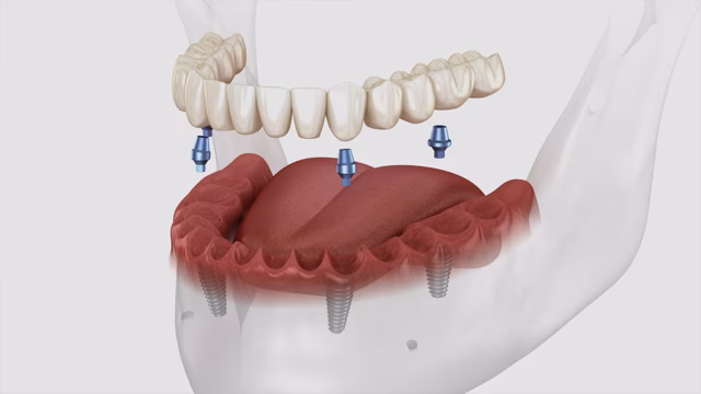 Teeth in a Day