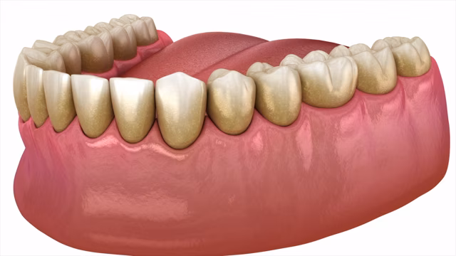 What is Gum Disease Video Thumbnail